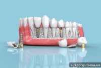 Does Turkey’s SGK Cover Dental Implants and How to Get 700 TL Support?