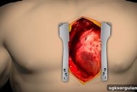 Does SGK Cover Bypass Surgery? 2026 Updated Regulations